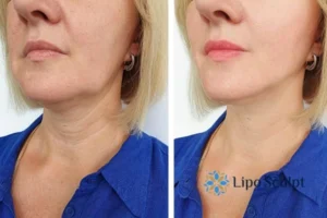 Double chin before and after Hi-Fu treatment 4 Book your double chin treatment Melksham today! We are here to help!