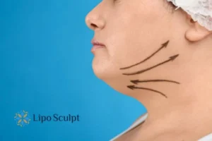 Double chin before and after Hi-Fu treatment 3 Boost your confidence with a Double chin treatment Melksham