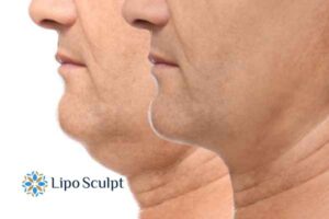 Double chin before and after Hi-Fu treatment 2 Double chin treatment Melksham from Lipo Sculpt - feel more confident today!