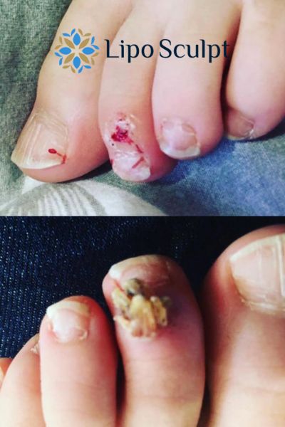 Wart removal customer results from Lipo Sculpt Melksham