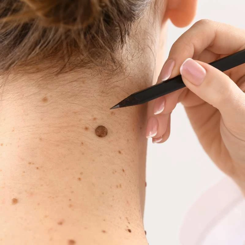 See our lesion removal prices Melksham - call today for a free quote